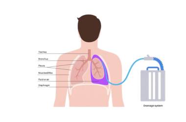 Chest Tube Inserting