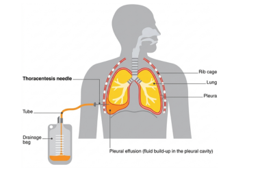 Pleural Fluid Tapping